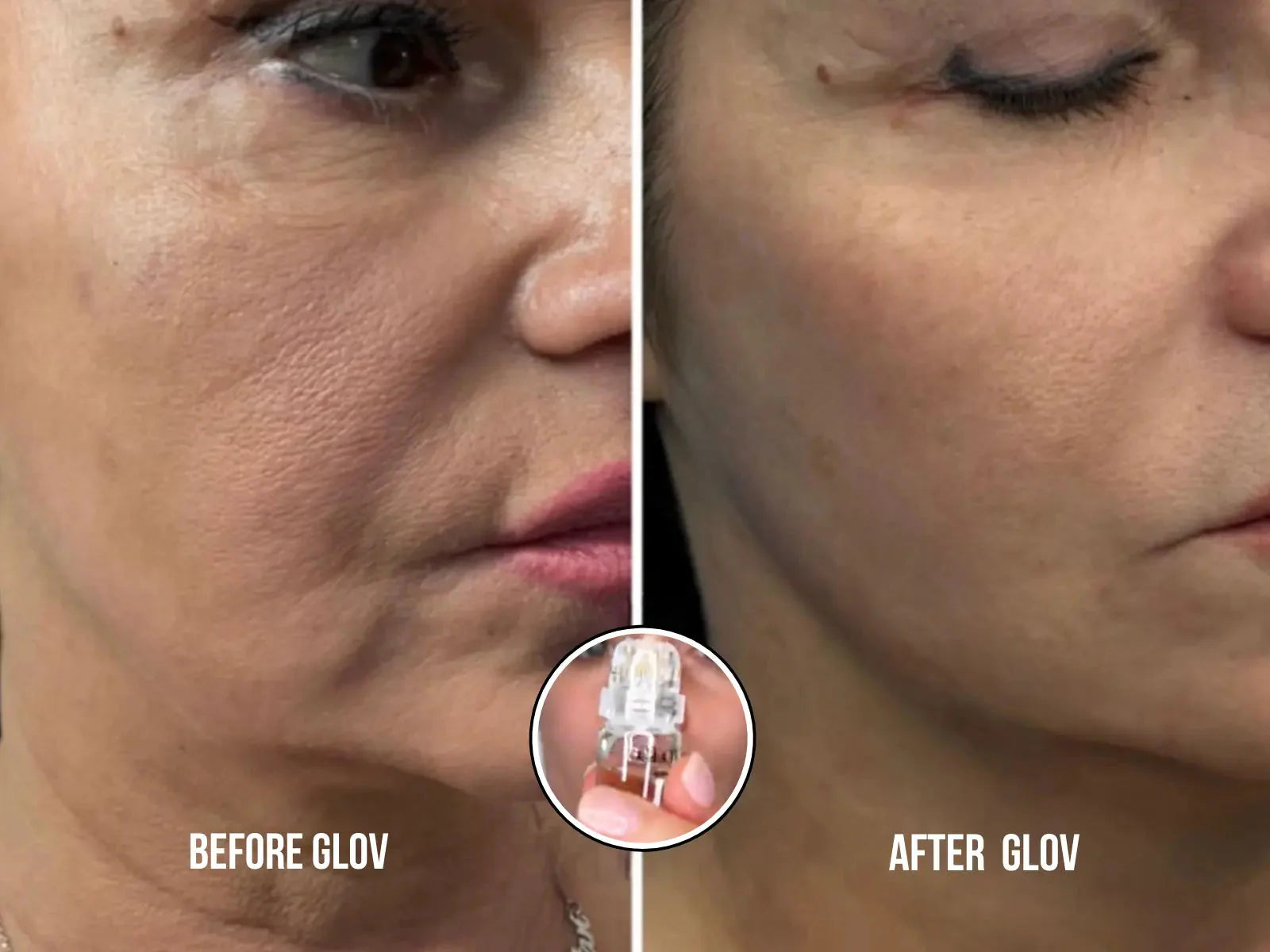 Système de perfusion Glov Micro